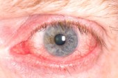 Eye-redness